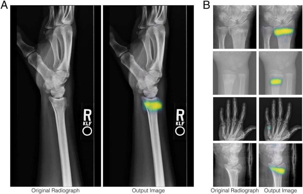 Détection automatique d'une fracture à l'aide du Deep Learning